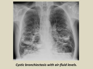Cystic bronchiectasis with air-fluid levels.
 