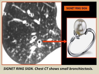 SIGNET RING SIGN. Chest CT shows small bronchiectasis.
 