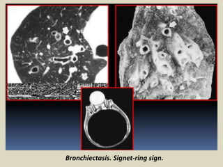 Bronchiectasis. Signet-ring sign.
 