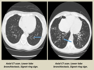 Axial CT scan. Lower lobe
bronchiectasis. Signet-ring sign.
Axial CT scan. Lower lobe
bronchiectasis. Signet-ring sign.
 