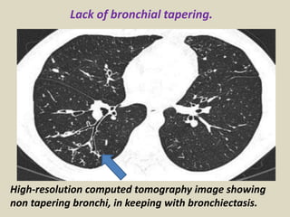 High-resolution computed tomography image showing
non tapering bronchi, in keeping with bronchiectasis.
Lack of bronchial tapering.
 