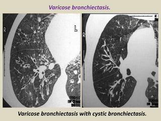 Varicose bronchiectasis.
Varicose bronchiectasis with cystic bronchiectasis.
 