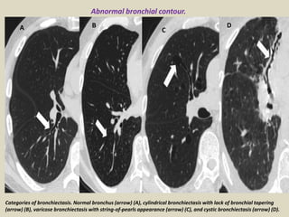 Categories of bronchiectasis. Normal bronchus (arrow) (A), cylindrical bronchiectasis with lack of bronchial tapering
(arrow) (B), varicose bronchiectasis with string-of-pearls appearance (arrow) (C), and cystic bronchiectasis (arrow) (D).
BA C
D
Abnormal bronchial contour.
 