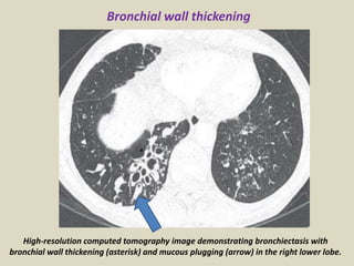 *
High-resolution computed tomography image demonstrating bronchiectasis with
bronchial wall thickening (asterisk) and mucous plugging (arrow) in the right lower lobe.
Bronchial wall thickening
 