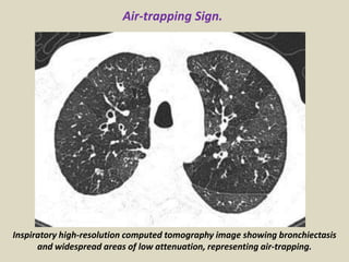 Inspiratory high-resolution computed tomography image showing bronchiectasis
and widespread areas of low attenuation, representing air-trapping.
Air-trapping Sign.
 