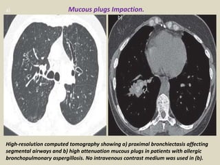 High-resolution computed tomography showing a) proximal bronchiectasis affecting
segmental airways and b) high attenuation mucous plugs in patients with allergic
bronchopulmonary aspergillosis. No intravenous contrast medium was used in (b).
a)
b)
Mucous plugs Impaction.
 