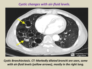 Cystic Bronchiectasis. CT: Markedly dilated bronchi are seen, some
with air-fluid levels (yellow arrows), mostly in the right lung.
Cystic changes with air-fluid levels.
 