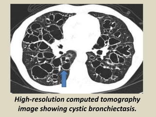 High-resolution computed tomography
image showing cystic bronchiectasis.
 