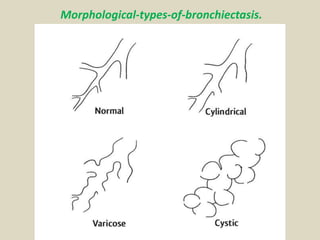 Morphological-types-of-bronchiectasis.
 