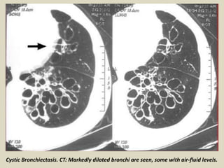 Cystic Bronchiectasis. CT: Markedly dilated bronchi are seen, some with air-fluid levels.
 