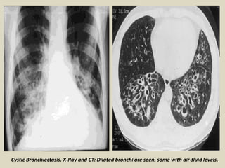 Cystic Bronchiectasis. X-Ray and CT: Dilated bronchi are seen, some with air-fluid levels.
 