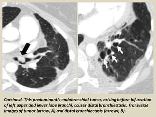 Carcinoid. This predominantly endobronchial tumor, arising before bifurcation
of left upper and lower lobe bronchi, causes distal bronchiectasis. Transverse
images of tumor (arrow, A) and distal bronchiectasis (arrows, B).
 