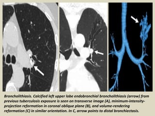 Broncholithiasis. Calcified left upper lobe endobronchial broncholithiasis (arrow) from
previous tuberculosis exposure is seen on transverse image (A), minimum-intensity-
projection reformation in coronal oblique plane (B), and volume-rendering
reformation (C) in similar orientation. In C, arrow points to distal bronchiectasis.
 