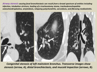 Congenital stenosis of left mainstem bronchus. Transverse images show
stenosis (arrow, A), distal bronchiectasis, and mucoid impaction (arrows, B).
Airway stenosis causing focal bronchiectasis can result from a broad spectrum of entities including
infection, intubation stricture, healing of a tracheostomy stoma, tracheobronchopathia
osteochondroplastica, amyloidosis, relapsing polychondritis, sarcoidosis, and fibrosing mediastinitis.
 