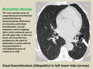 Focal bronchiectasis (idiopathic) in left lower lobe (arrow).
Bronchial Atresia
The most common cause of
congenital focal bronchiectasis
is bronchial atresia,
characterized by obliteration
of a bronchus with distal
bronchiectasis, mucoid
impaction, and air trapping
that is most commonly seen in
the left upper lobe. In this rare
lesion, the bronchial tree
peripheral to the point of
obliteration is patent and the
lung parenchyma is
overinflated because of
collateral air drift.
 