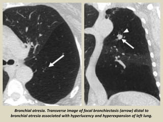 Bronchial atresia. Transverse image of focal bronchiectasis (arrow) distal to
bronchial atresia associated with hyperlucency and hyperexpansion of left lung.
 
