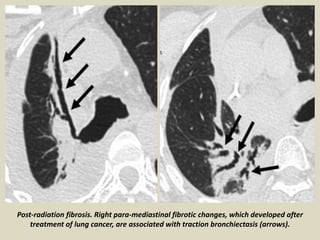 Post-radiation fibrosis. Right para-mediastinal fibrotic changes, which developed after
treatment of lung cancer, are associated with traction bronchiectasis (arrows).
 