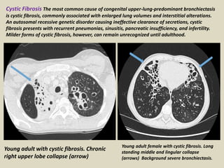 Young adult with cystic fibrosis. Chronic
right upper lobe collapse (arrow)
Young adult female with cystic fibrosis. Long
standing middle and lingular collapse
(arrows) Background severe bronchiectasis.
Cystic Fibrosis The most common cause of congenital upper-lung-predominant bronchiectasis
is cystic fibrosis, commonly associated with enlarged lung volumes and interstitial alterations.
An autosomal recessive genetic disorder causing ineffective clearance of secretions, cystic
fibrosis presents with recurrent pneumonias, sinusitis, pancreatic insufficiency, and infertility.
Milder forms of cystic fibrosis, however, can remain unrecognized until adulthood.
 