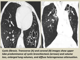 Cystic fibrosis. Transverse (A) and coronal (B) images show upper
lobe predominance of cystic bronchiectasis (arrows) and volume
loss, enlarged lung volumes, and diffuse heterogeneous attenuation.
 