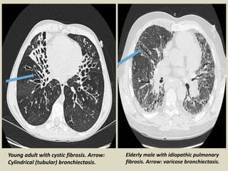 Young adult with cystic fibrosis. Arrow:
Cylindrical (tubular) bronchiectasis.
Elderly male with idiopathic pulmonary
fibrosis. Arrow: varicose bronchiectasis.
 