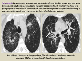 Sarcoidosis. Transverse images show fibrosis and traction bronchiectasis
(arrows, B) that predominantly involve upper lobes.
Sarcoidosis Parenchymal involvement by sarcoidosis can lead to upper and mid lung
fibrosis and traction bronchiectasis, typically associated with multiple nodules in a
perilymphatic distribution. Mediastinal and bilateral symmetric lymphadenopathy is
common, although it can regress as the interstitial disease worsens
 