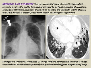 Kartagener's syndrome. Transverse CT image confirms dextrocardia (asterisk is in left
ventricle) and bronchiectasis (arrows) that predominantly affects midportion of lungs.
Immobile Cilia Syndrome This rare congenital cause of bronchiectasis, which
primarily involves the middle lung, is characterized by ineffective clearing of secretions,
causing bronchiectasis, recurrent pneumonias, sinusitis, and infertility. In 50% of cases,
total situs inversus is present, a condition known as Kartagener's syndrome.
 