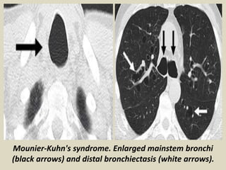 Mounier-Kuhn's syndrome. Enlarged mainstem bronchi
(black arrows) and distal bronchiectasis (white arrows).
 