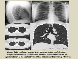 Mounier-Kuhn syndrome, also known as tracheobronchomegaly, is a rare
congenital abnormality of the trachea and main bronchi characterized by
cystic dilatation of the tracheobronchial tree and recurrent respiratory infections.
 
