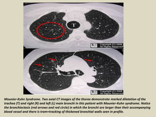 Mounier-Kuhn Syndrome. Two axial CT images of the thorax demonstrate marked dilatation of the
trachea (T) and right (R) and left (L) main bronchi in this patient with Mounier-Kuhn syndrome. Notice
the bronchiectasis (red arrows and red circle) in which the bronchi are larger than their accompanying
blood vessel and there is tram=tracking of thickened bronchial walls seen in profile.
 