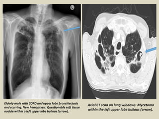 Elderly male with COPD and upper lobe bronchiectasis
and scarring. New hemoptysis. Questionable soft tissue
nodule within a left upper lobe bullous (arrow).
Axial CT scan on lung windows. Mycetoma
within the left upper lobe bullous (arrow).
 