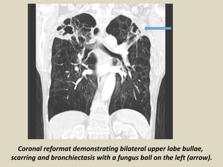 Coronal reformat demonstrating bilateral upper lobe bullae,
scarring and bronchiectasis with a fungus ball on the left (arrow).
 