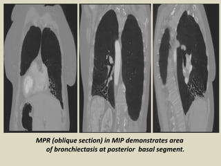 MPR (oblique section) in MIP demonstrates area
of bronchiectasis at posterior basal segment.
 