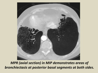MPR (axial section) in MIP demonstrates areas of
bronchiectasis at posterior basal segments at both sides.
 
