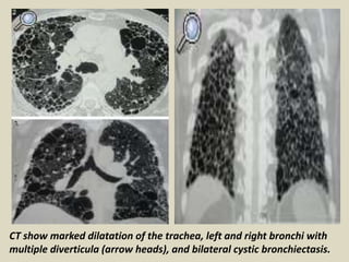 CT show marked dilatation of the trachea, left and right bronchi with
multiple diverticula (arrow heads), and bilateral cystic bronchiectasis.
 