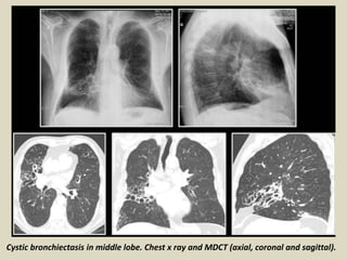 Cystic bronchiectasis in middle lobe. Chest x ray and MDCT (axial, coronal and sagittal).
 