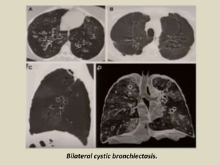 Bilateral cystic bronchiectasis.
 