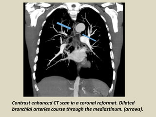 Contrast enhanced CT scan in a coronal reformat. Dilated
bronchial arteries course through the mediastinum. (arrows).
 