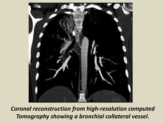Coronal reconstruction from high-resolution computed
Tomography showing a bronchial collateral vessel.
 
