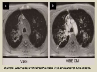 Bilateral upper lobes cystic bronchiectasis with air fluid level, MRI images.
 