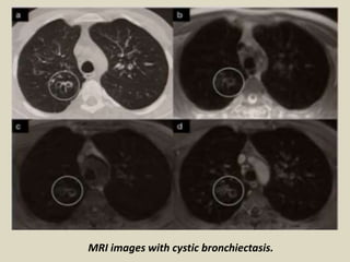 MRI images with cystic bronchiectasis.
 