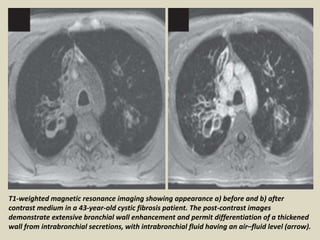 T1-weighted magnetic resonance imaging showing appearance a) before and b) after
contrast medium in a 43-year-old cystic fibrosis patient. The post-contrast images
demonstrate extensive bronchial wall enhancement and permit differentiation of a thickened
wall from intrabronchial secretions, with intrabronchial fluid having an air–fluid level (arrow).
 