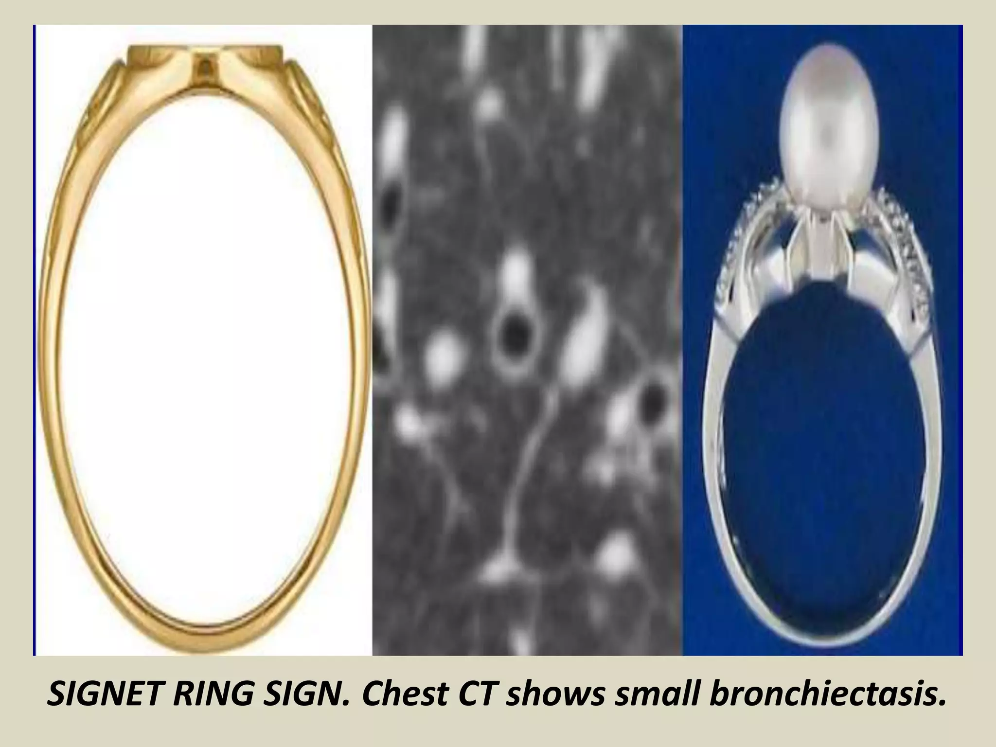 SIGNET RING SIGN. Chest CT shows small bronchiectasis.
 