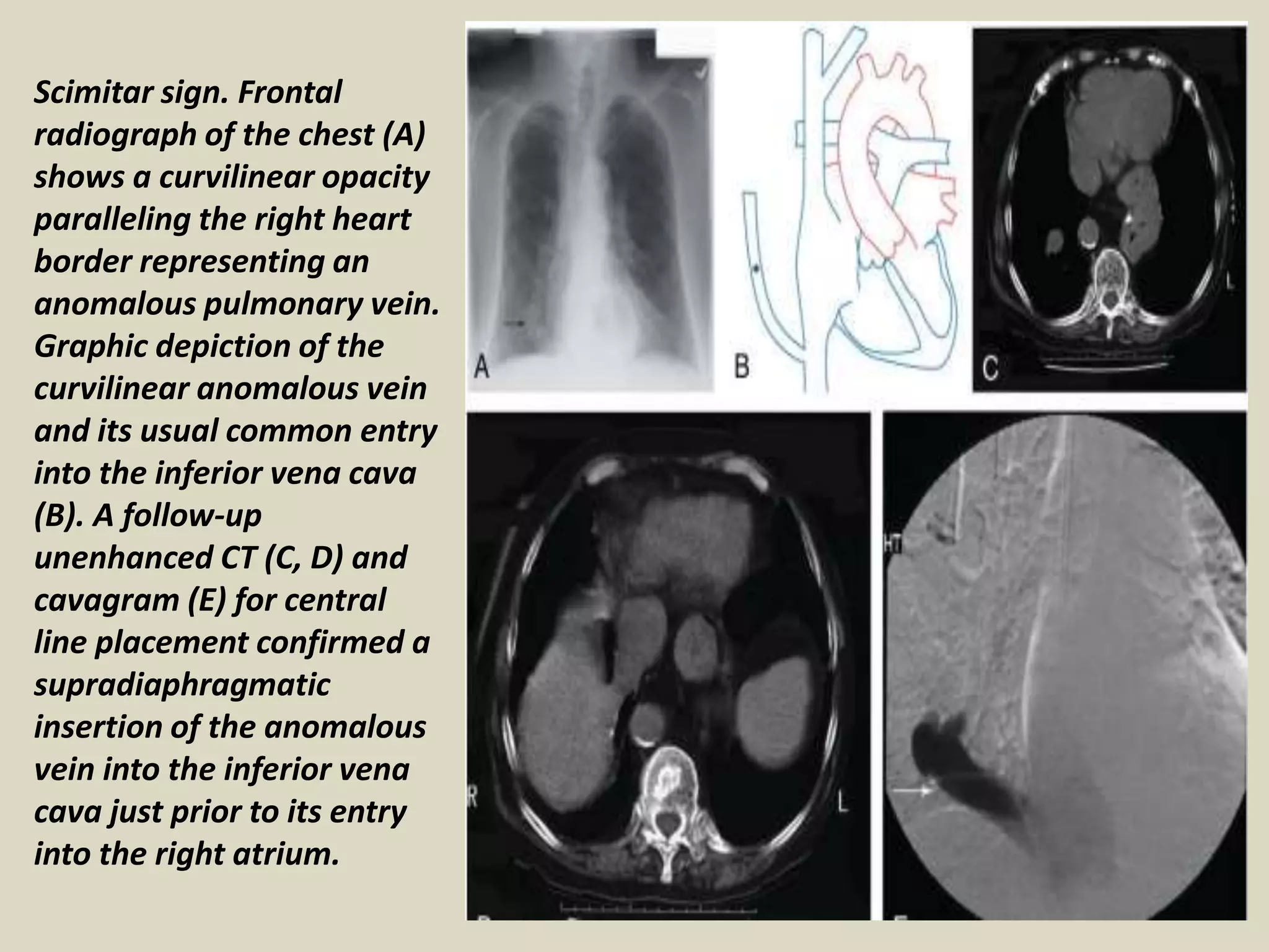 Scimitar sign. Frontal
radiograph of the chest (A)
shows a curvilinear opacity
paralleling the right heart
border representing an
anomalous pulmonary vein.
Graphic depiction of the
curvilinear anomalous vein
and its usual common entry
into the inferior vena cava
(B). A follow-up
unenhanced CT (C, D) and
cavagram (E) for central
line placement confirmed a
supradiaphragmatic
insertion of the anomalous
vein into the inferior vena
cava just prior to its entry
into the right atrium.
 