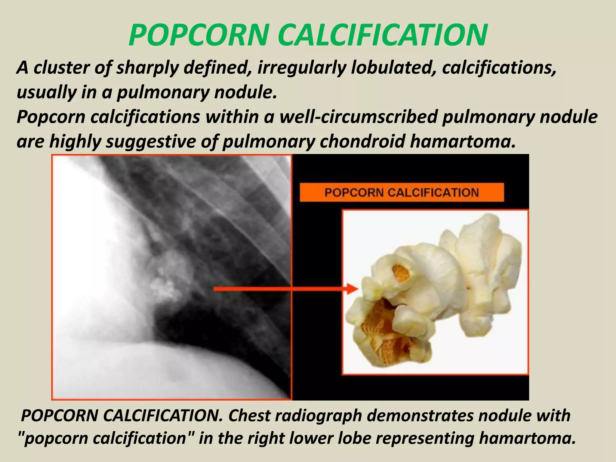 POPCORN CALCIFICATION
A cluster of sharply defined, irregularly lobulated, calcifications,
usually in a pulmonary nodule.
Popcorn calcifications within a well-circumscribed pulmonary nodule
are highly suggestive of pulmonary chondroid hamartoma.
POPCORN CALCIFICATION. Chest radiograph demonstrates nodule with
"popcorn calcification" in the right lower lobe representing hamartoma.
 