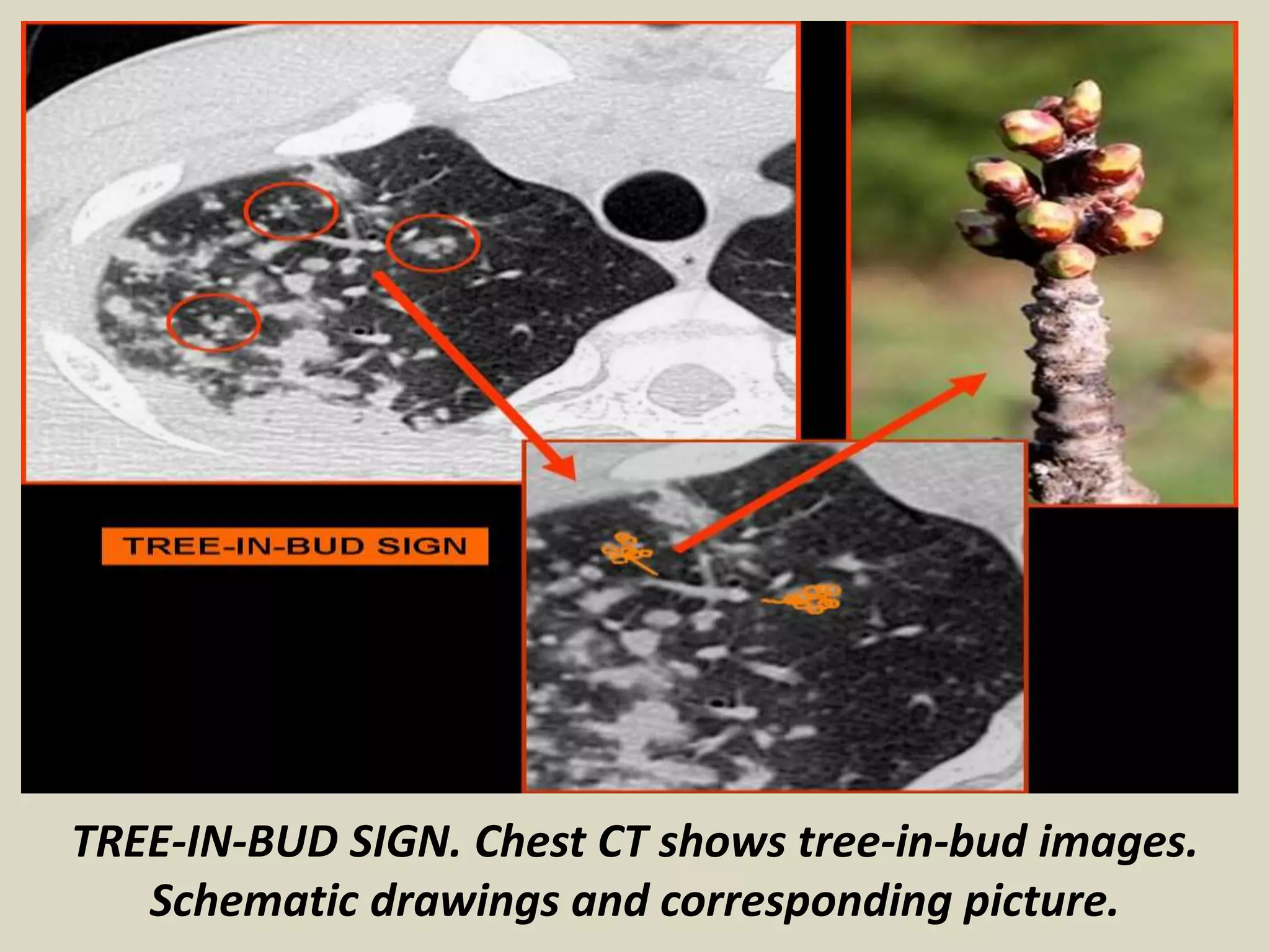 TREE-IN-BUD SIGN. Chest CT shows tree-in-bud images.
Schematic drawings and corresponding picture.
 