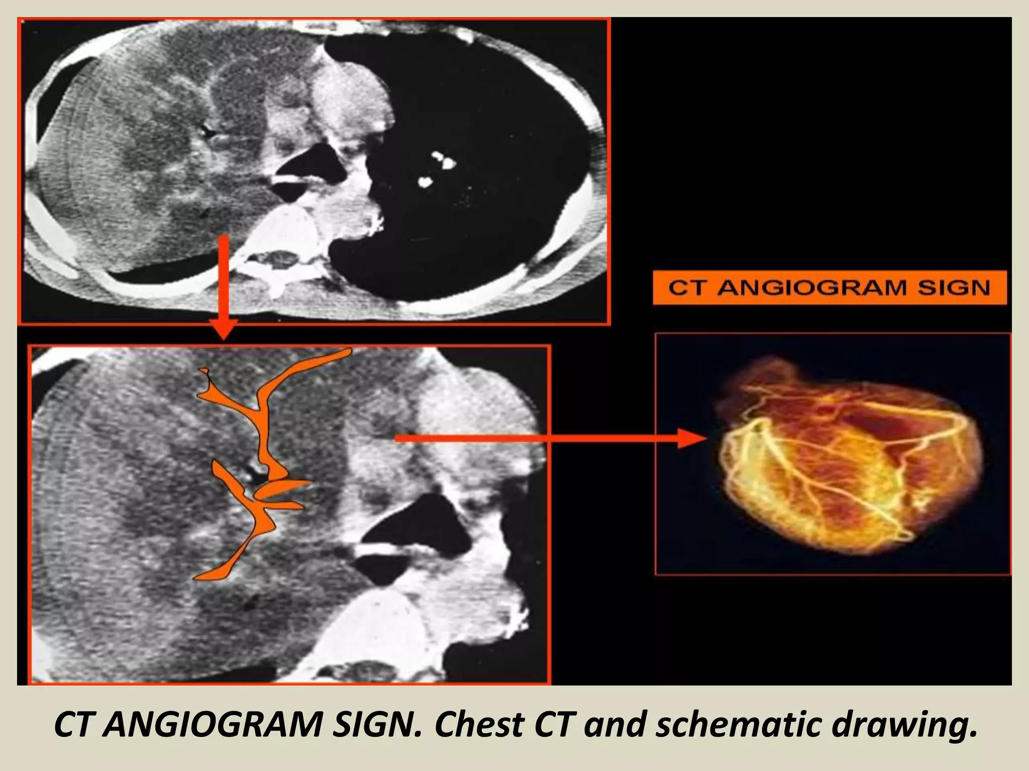 CT ANGIOGRAM SIGN. Chest CT and schematic drawing.
 