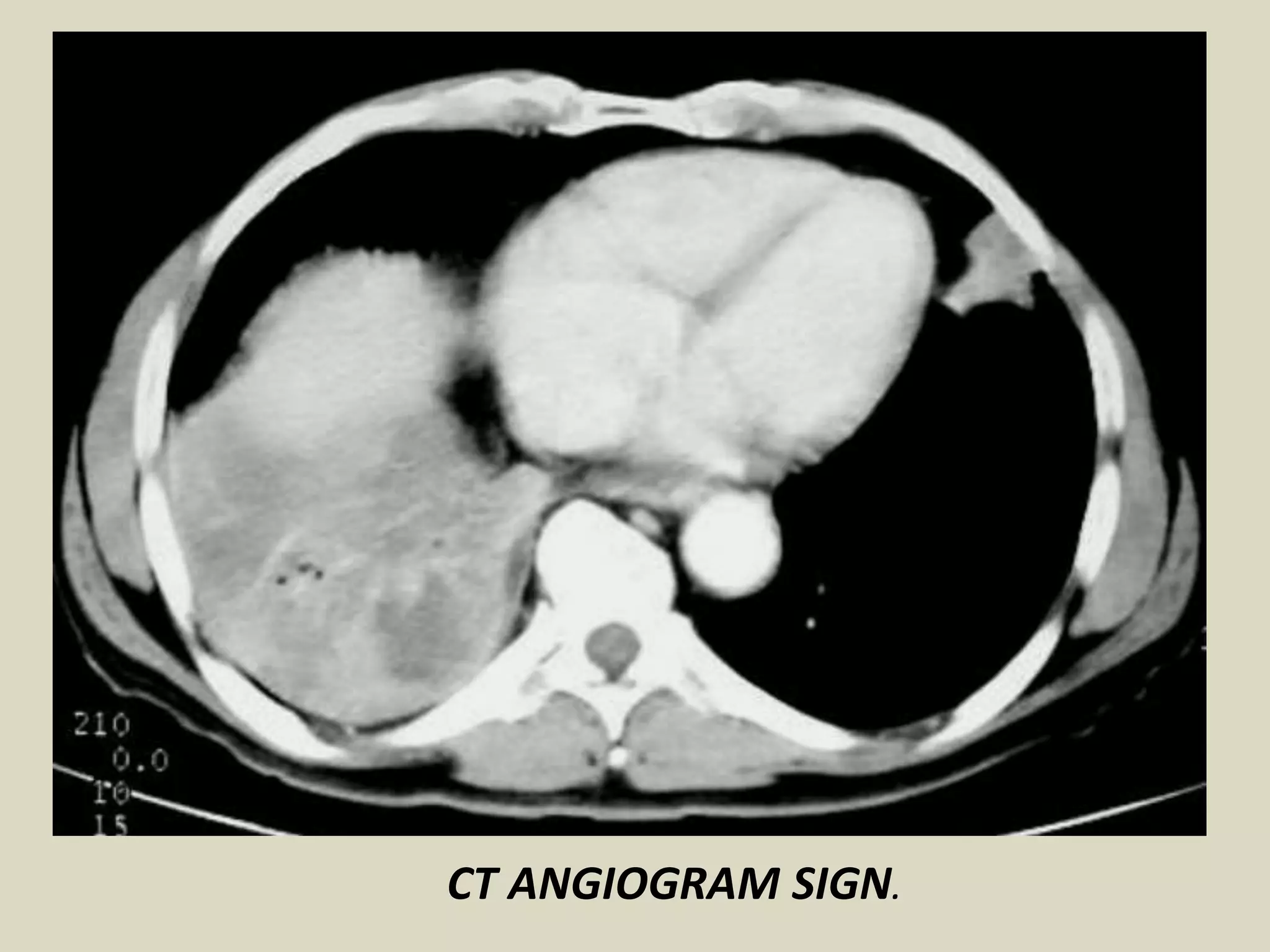 CT ANGIOGRAM SIGN.
 