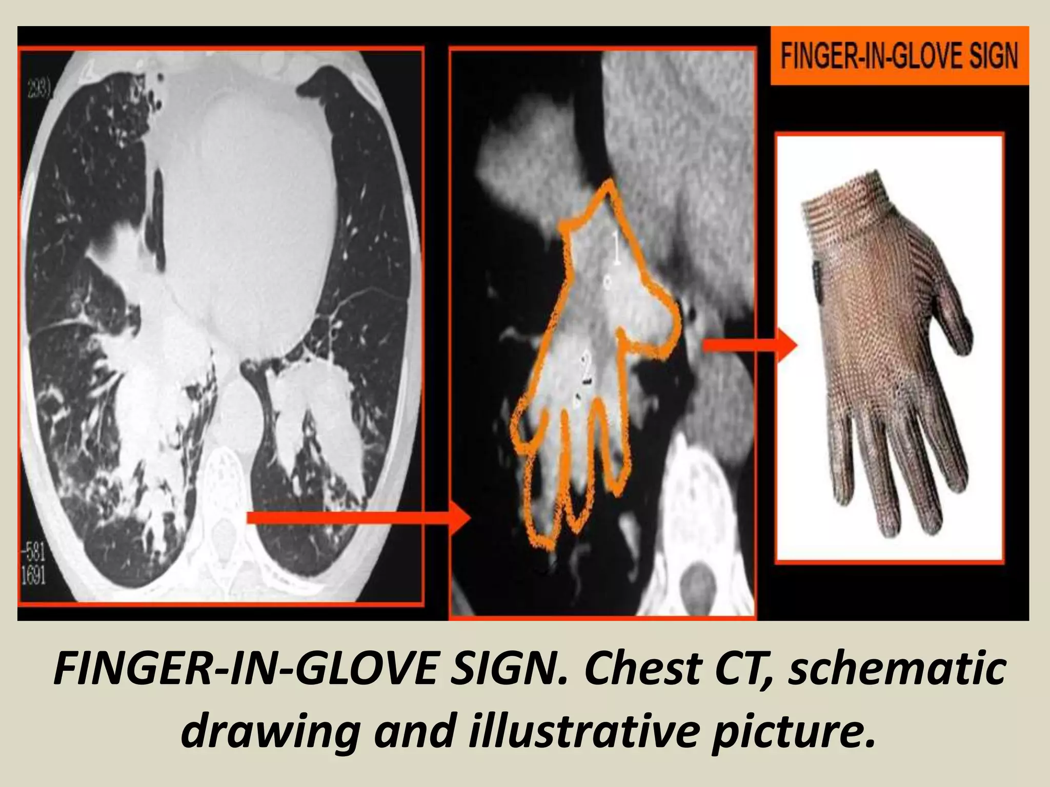 FINGER-IN-GLOVE SIGN. Chest CT, schematic
drawing and illustrative picture.
 