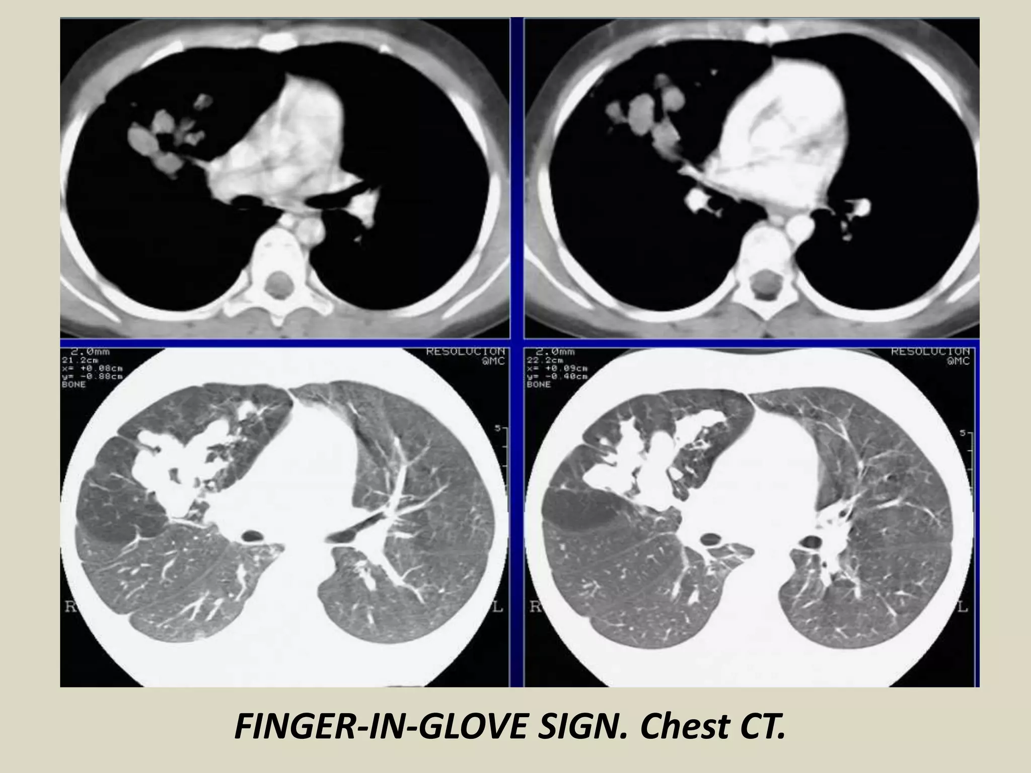 FINGER-IN-GLOVE SIGN. Chest CT.
 
