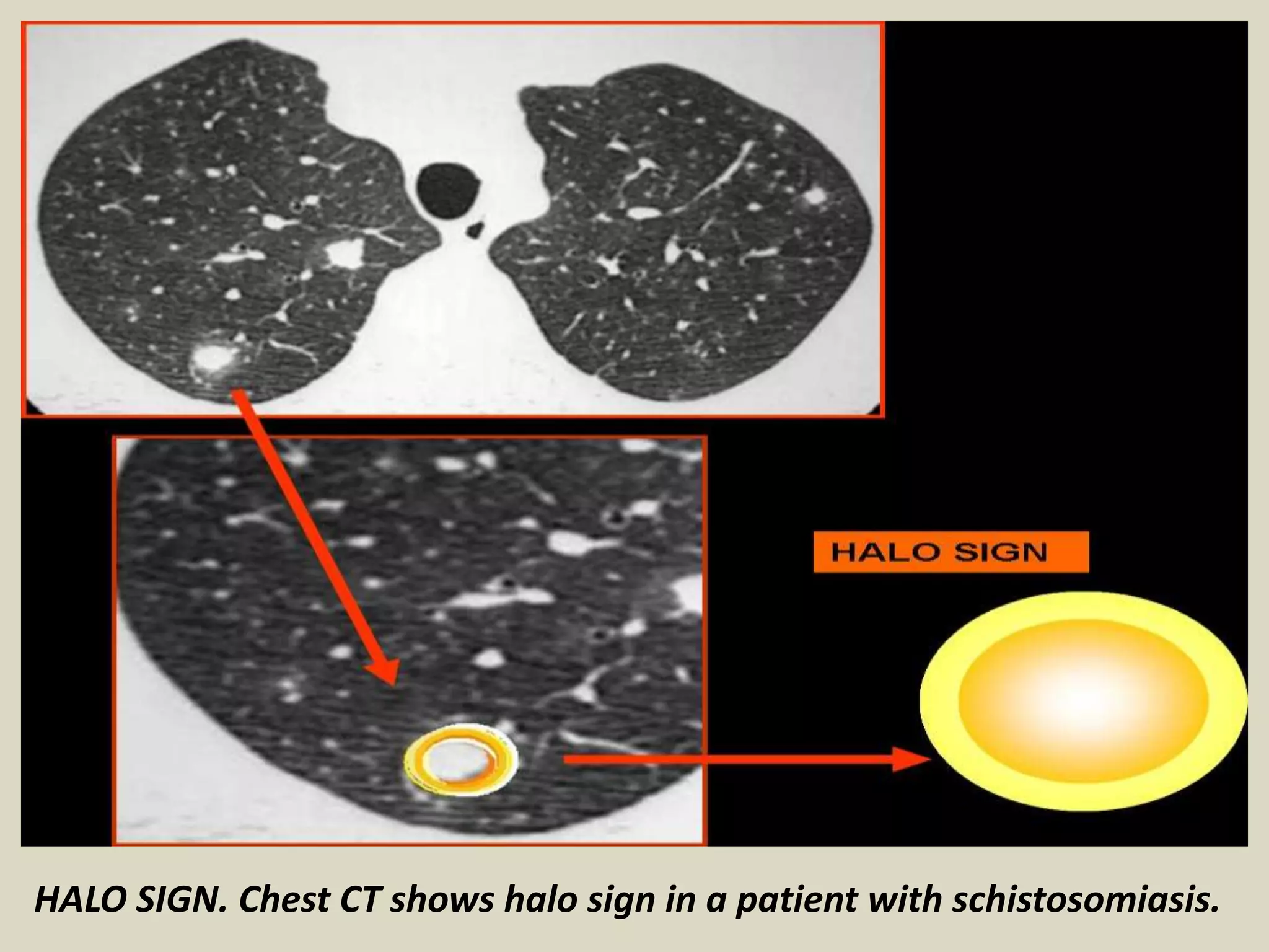 HALO SIGN. Chest CT shows halo sign in a patient with schistosomiasis.
 